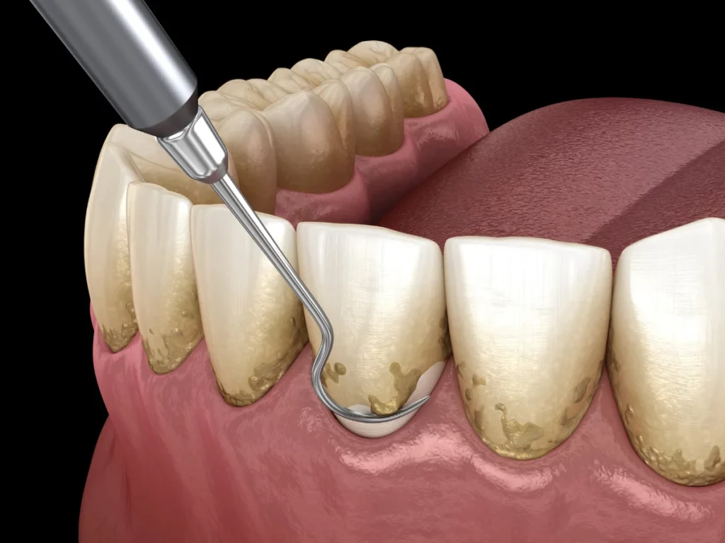 Treating a periodontal disease